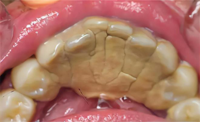 不出门解决牙结石方法分享！这些生活小妙招要知道！(图1)