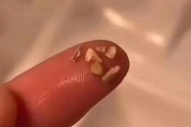 不出门解决牙结石方法分享！这些生活小妙招要知道！(图3)