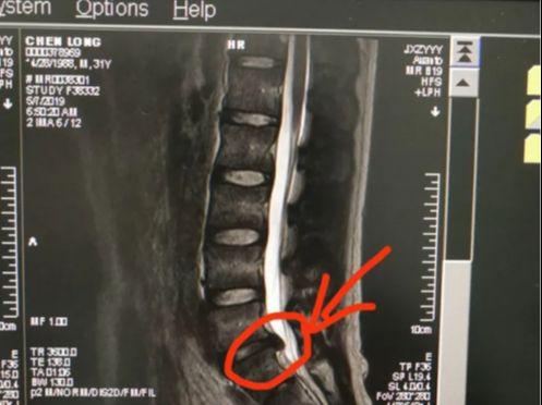 多年腰突难彩神恢复怎么办？学会这三个小妙招1个月恢复不是梦！(图1)